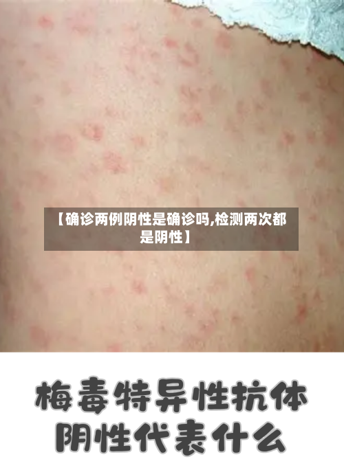 【确诊两例阴性是确诊吗,检测两次都是阴性】