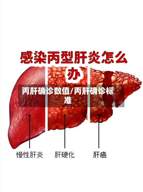 丙肝确诊数值/丙肝确诊标准